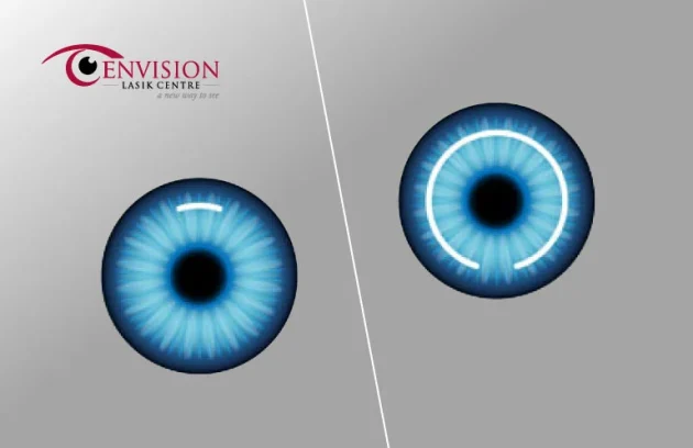Difference Between Relex SMILE and Contoura Vision LASIK