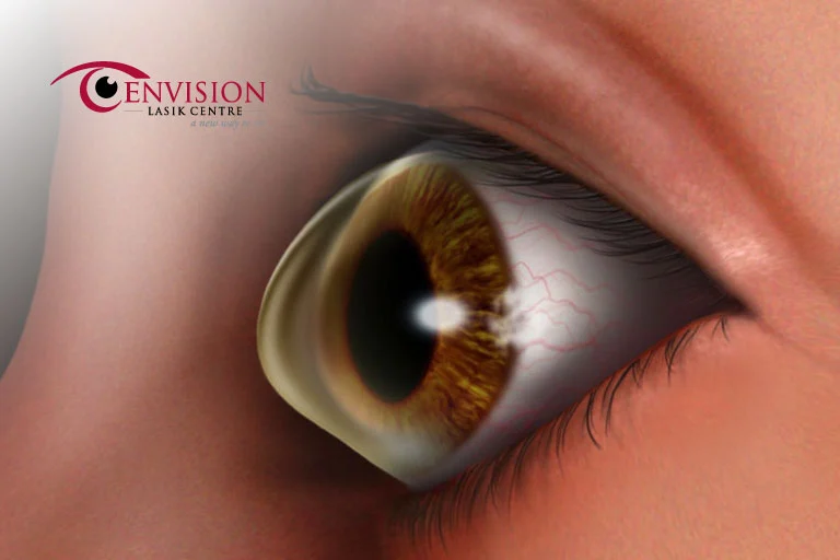 Keratoconus-is-it-a-serious-eye-disease