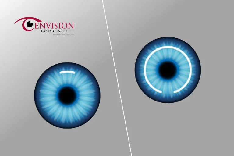 Difference Between Relex SMILE and Contoura Vision LASIK