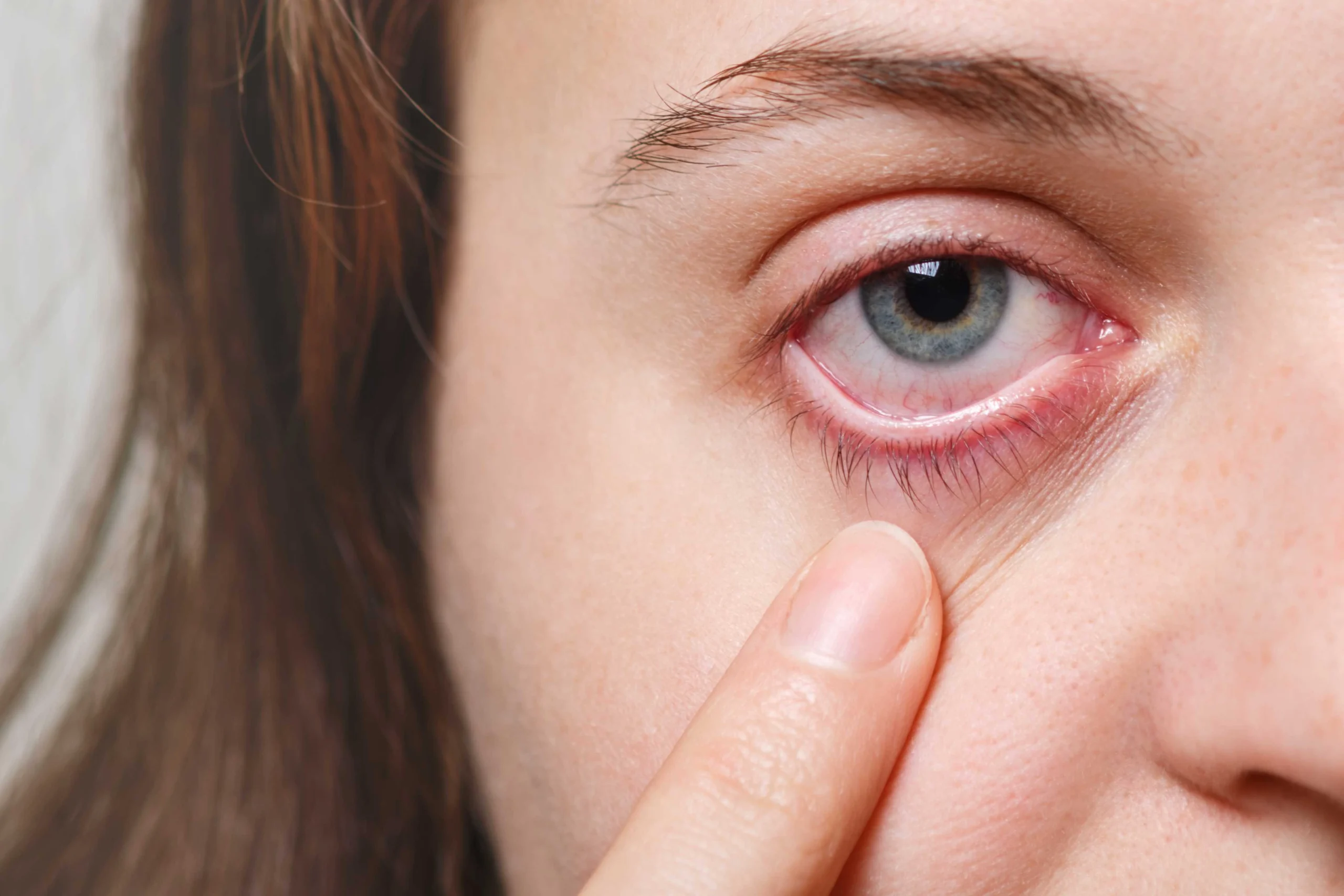 Does Keratoconus Cause Eye Pain?