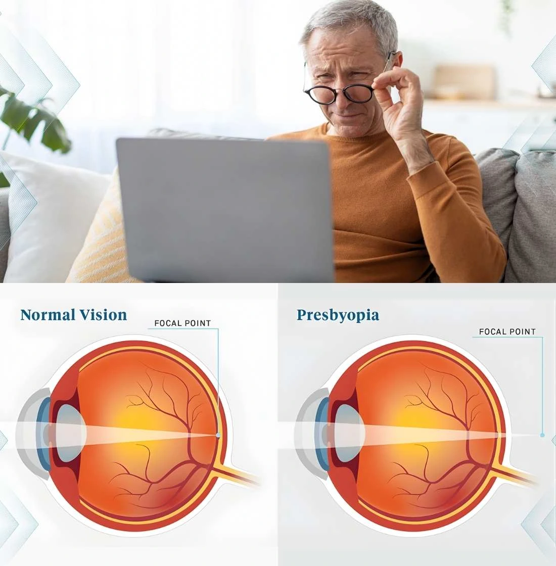 Understanding Presbyopia