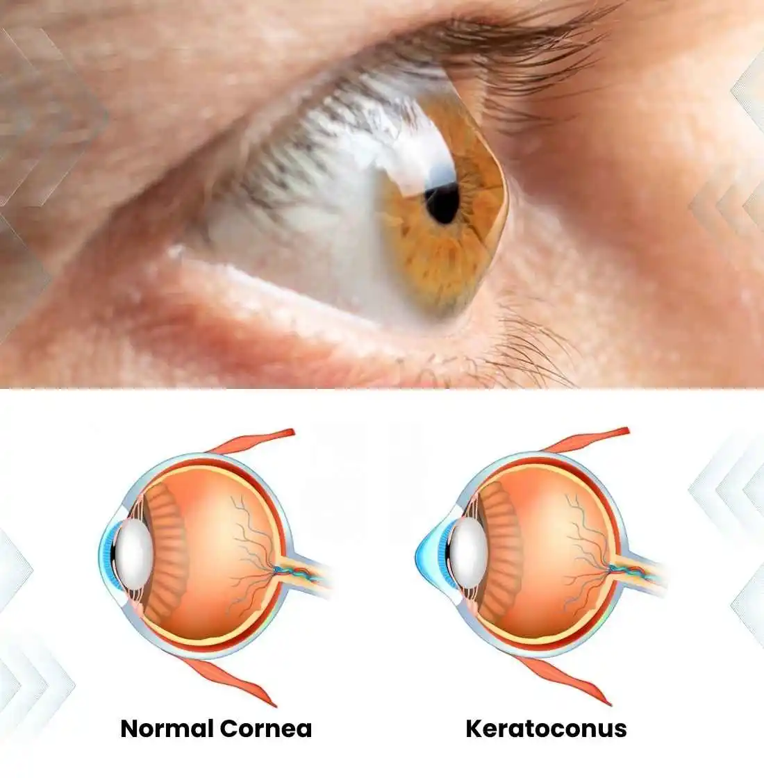 Understanding keratoconus Understanding keratoconus